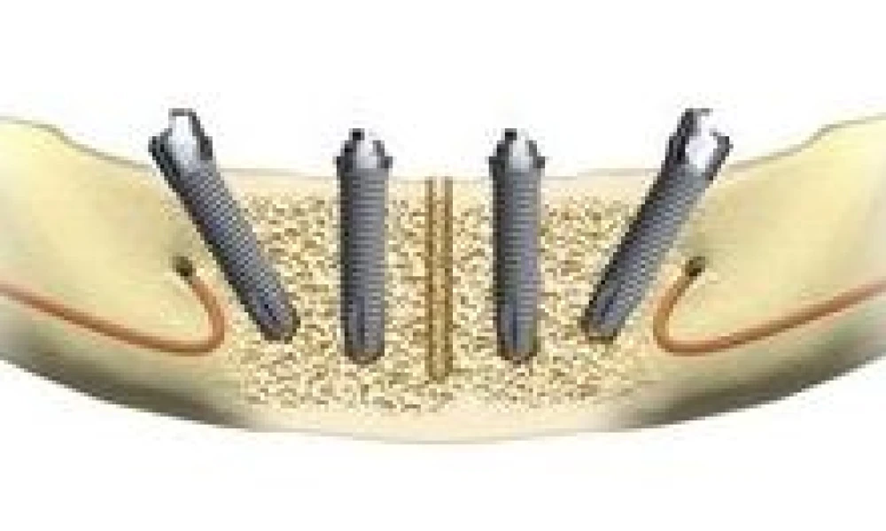 Clinical photo from Ron's dental implant case